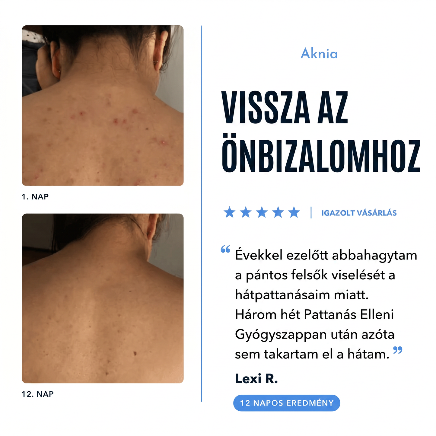 Aknia - Pattanás Elleni Gyógyszappan